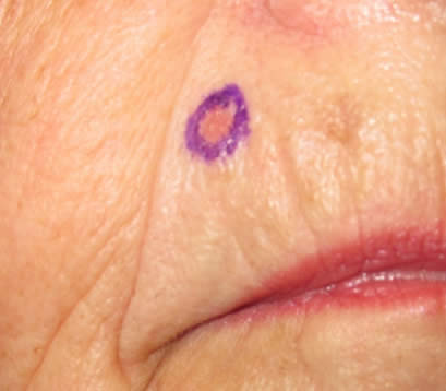 Skin cancer on upper lip before MOHS surgery